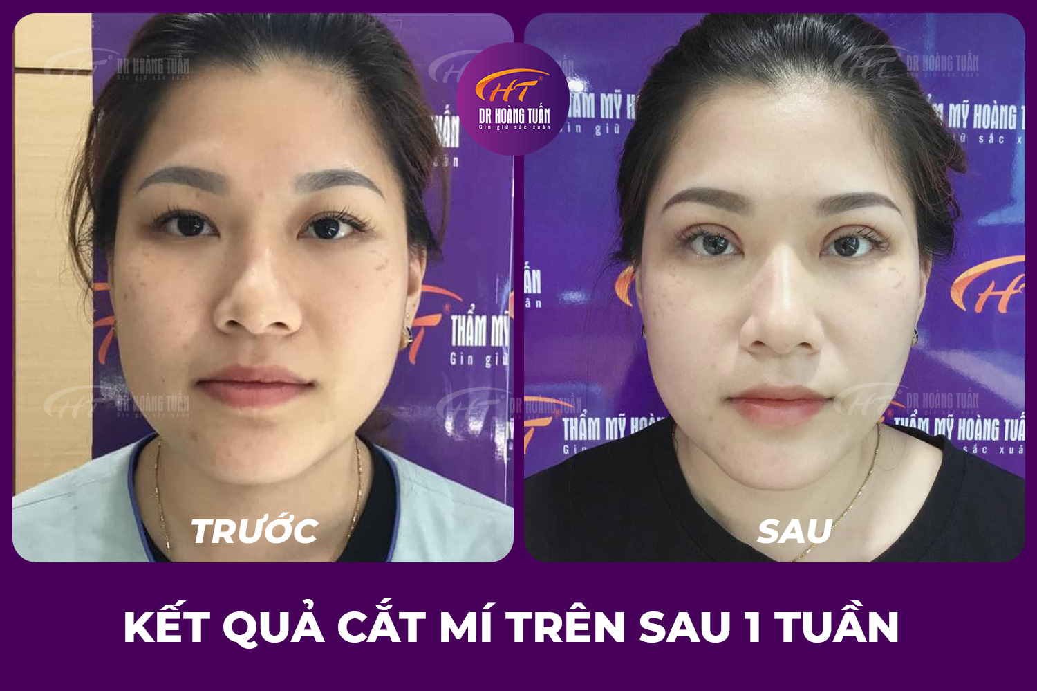Cắt mí trên đẹp tự nhiên